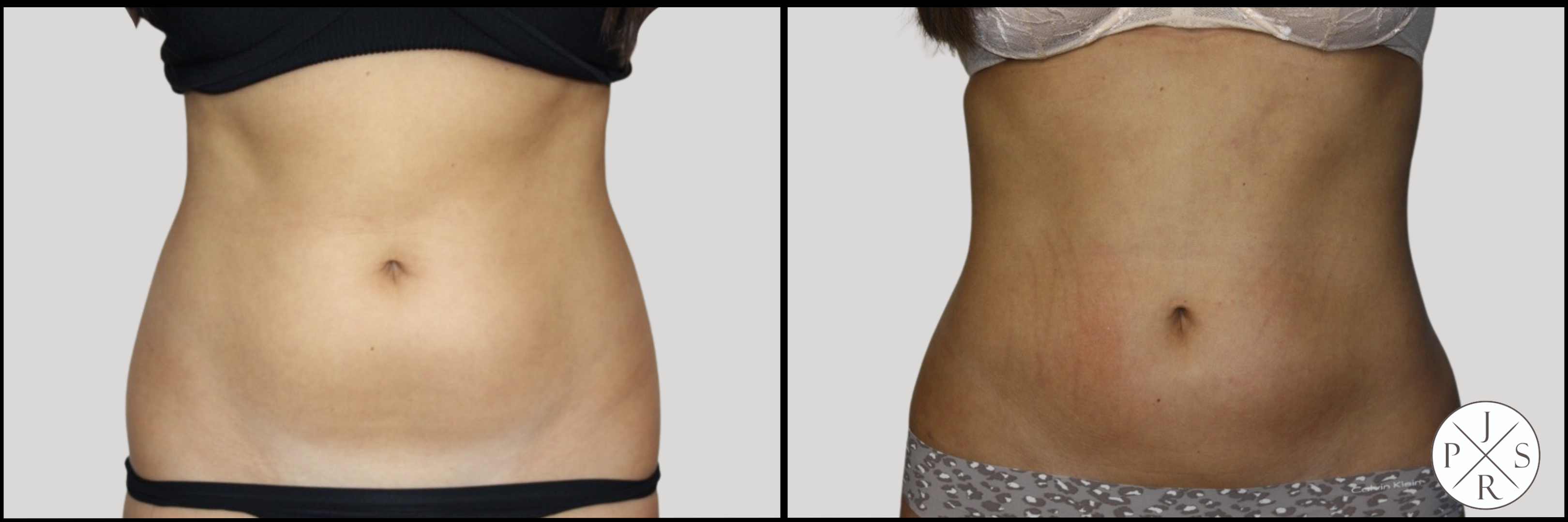 Liposuction Before & After Image